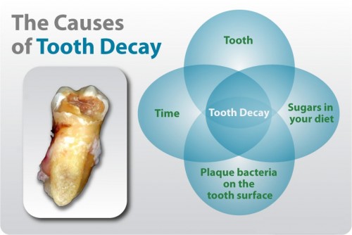 Causes-of-tooth-decay.jpg